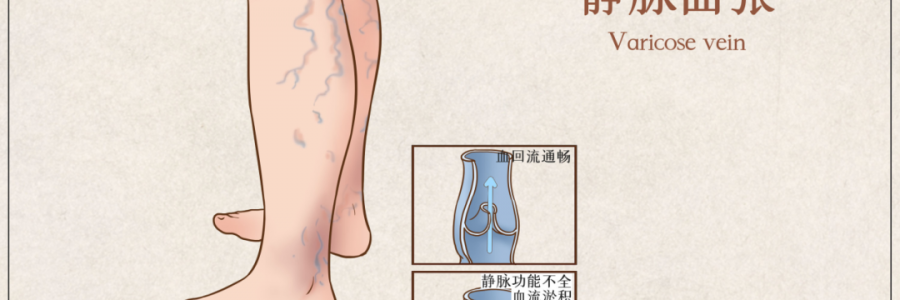 告別“蚯蚓腿”，靜脈曲張?jiān)趺凑{(diào)？