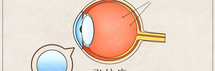 “蚊子”在眼里飛？這類人要注意了！
