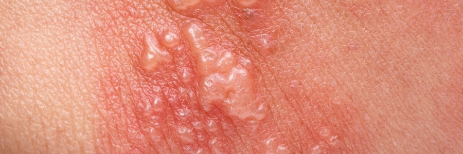 艾灸后起了小水泡，居然是邪氣在“逃跑”！