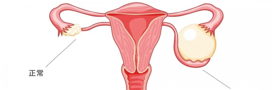 太神奇了，艾灸調(diào)好了她的卵巢囊腫！